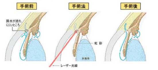 SLT手術